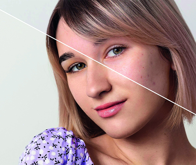 Akne İzleri ve Cilt Lekelerinde Fraksiyonel Lazer Ne Kadar Etkilidir?