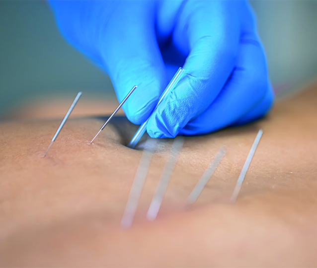 İğneli Epilasyon Nedir? Kalıcı &Ccedil;&ouml;z&uuml;m Hakkında Bilmeniz Gerekenler