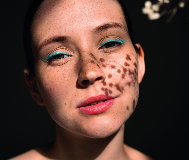 Leke Tedavisinde Kullanılan Medikal Y&ouml;ntemler Nelerdir?