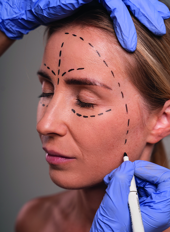 Endolift Lazer Uygulaması